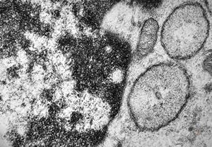 M,33y. | blood - hairy cell leukemia- ribosome-lamella complexin tricholeukocyte M,33y. | blood - hairy cell leukemia- ribosome-lamella complexin tricholeukocyte